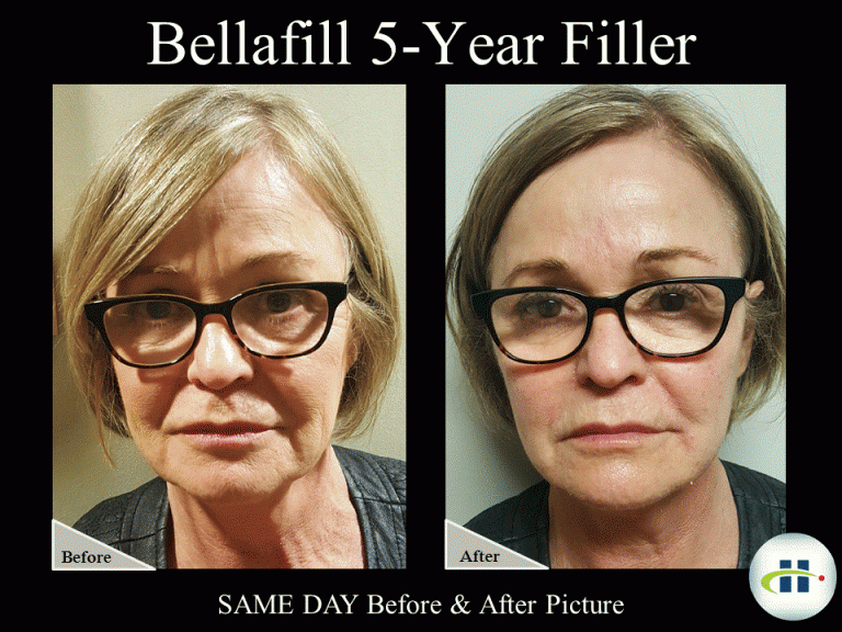 Bellafill Before & After Picture