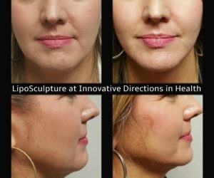 Slim Your Chin â€“ Removing Extra Fat