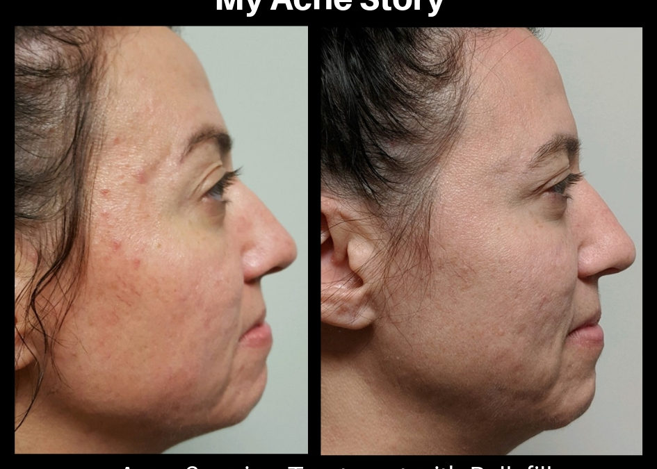 My Acne Story: How the scarring has affected me and treatment has changed my life.