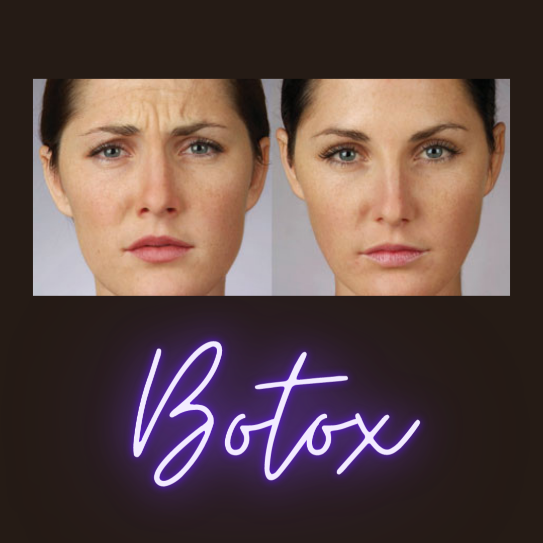 before after Botox