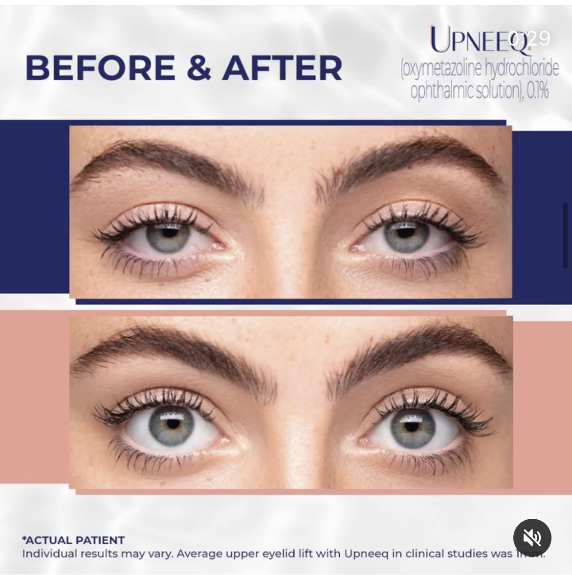 upneeq before after
