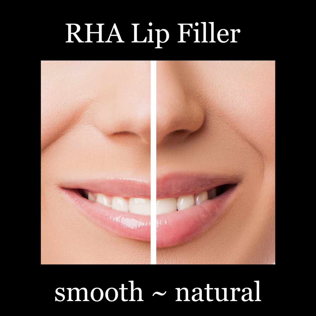 RHA Lip Filler 2